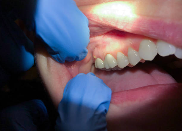 Best Emergency Dental Care for Sports Injuries in Holly Springs, GA
